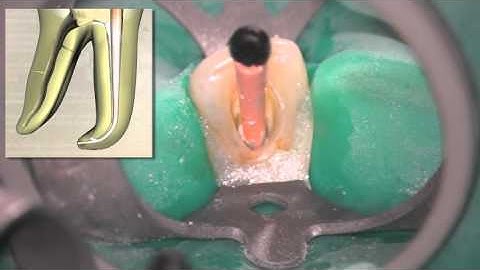 Calamus®  – Warm Vertical Master Cone Fit | Dentsply Sirona