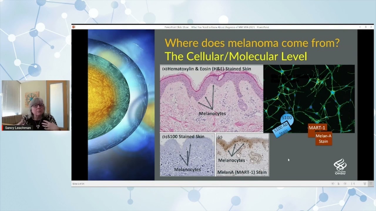What You Need to Know: Diagnosing Melanoma @MelanomaReAlli