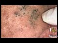 Dr pop   deep blackheads in old skin removing  treatment 2020 part 4