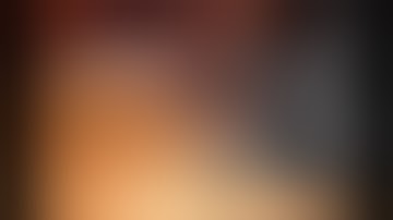 Single Port Cholecystectomy ( Laparoscopic & Robotic )