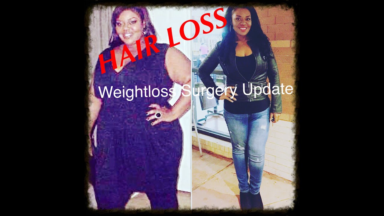 Hairloss After Weight Loss Surgery YouTube