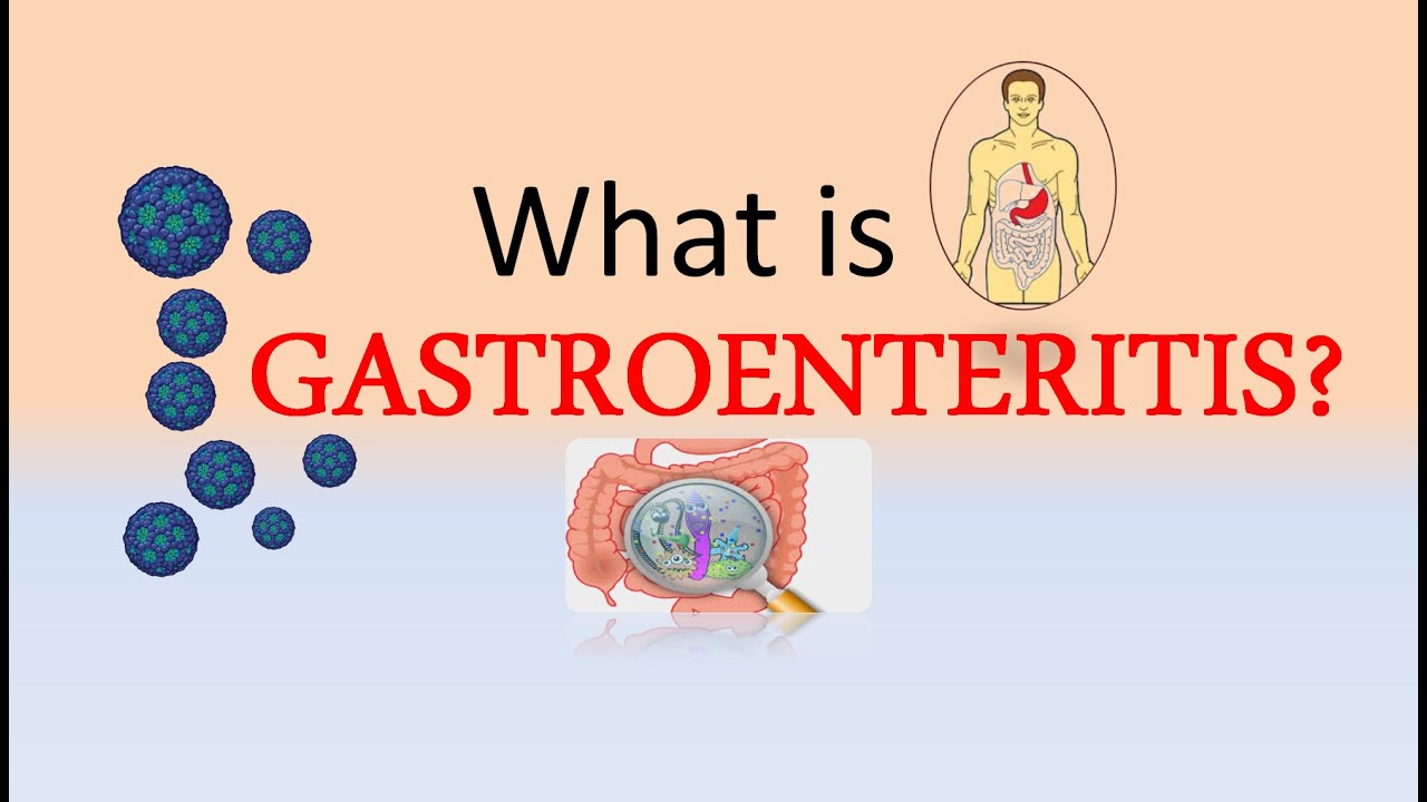 What Is Gastroenteritis ICD 10 Codes For Gastroenteritis YouTube