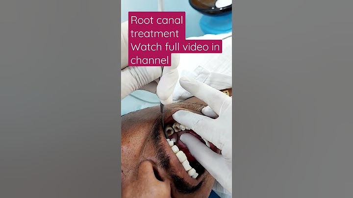 #rootcanaltreatment #doctors #rootcanaltreatment #doctors #toothcavity #zirconiacrown #rct #filling