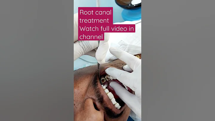 #rootcanaltreatment #doctors #rootcanaltreatment #doctors #toothcavity #zirconiacrown #rct #filling - DayDayNews
