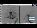 Lenox Hill Neurosurgery Webinar Series: Cerebrovascular and Neuroendovascular Conference | 6/25/2020