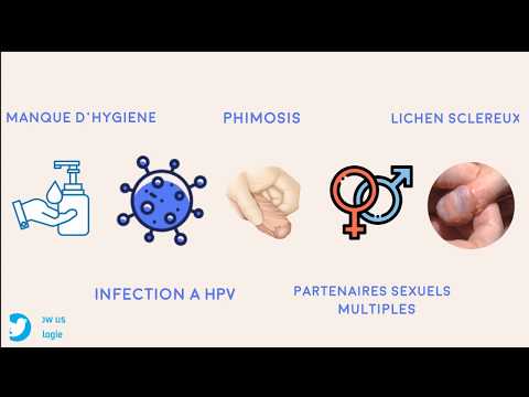 Vidéo: Masse Sur Le Pénis: Causes Possibles, Symptômes Et Traitements