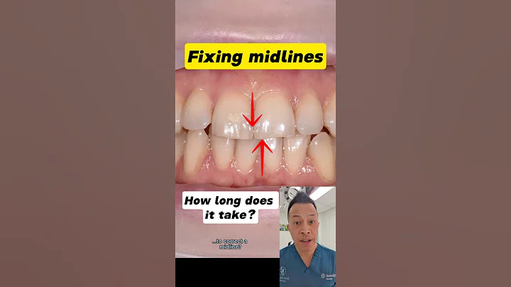 How Quickly Can You Fix a Dental Midline? #dentallan #dentist #shorts
