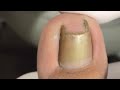 Easy treatment for narrow nail