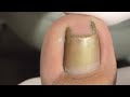 Easy treatment for narrow nail