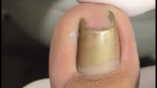 Easy treatment for narrow nail