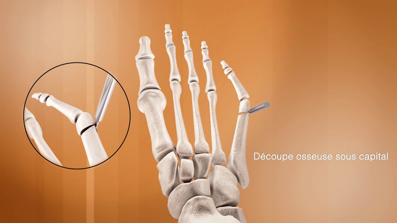 Chirurgie Du Pied Clinique Du Parc Caen