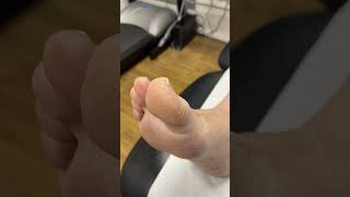 Watch The Art Of Callus Removal! Perfect Big Toe Transformation By Our Expert Podiatrist. #Podiatrym