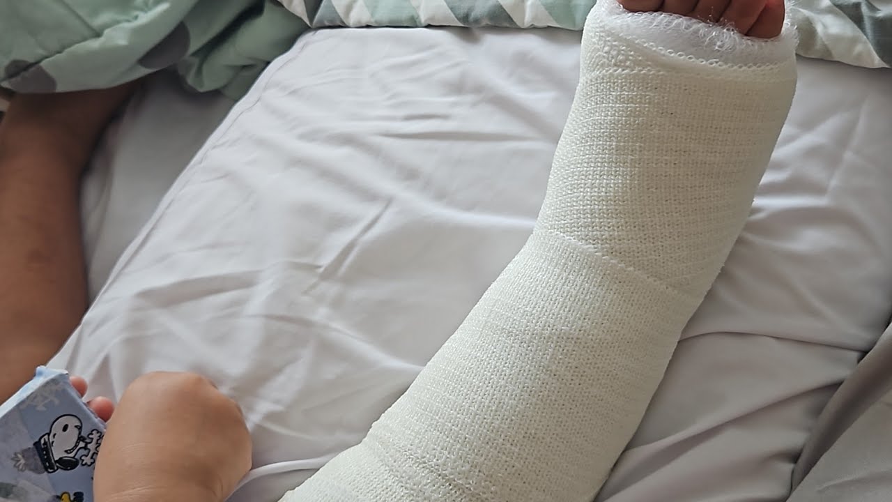 4 weeks laid up with a broken leg - YouTube