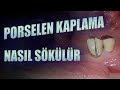 Porselen Kaplama Nasıl Sökülür?