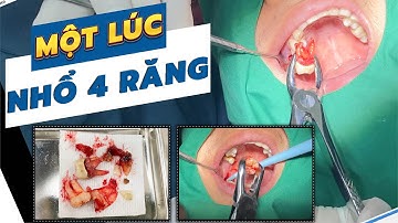 Nhổ 4 răng hàm cùng lúc - Ác mộng "Nhổ răng" có đáng sợ?