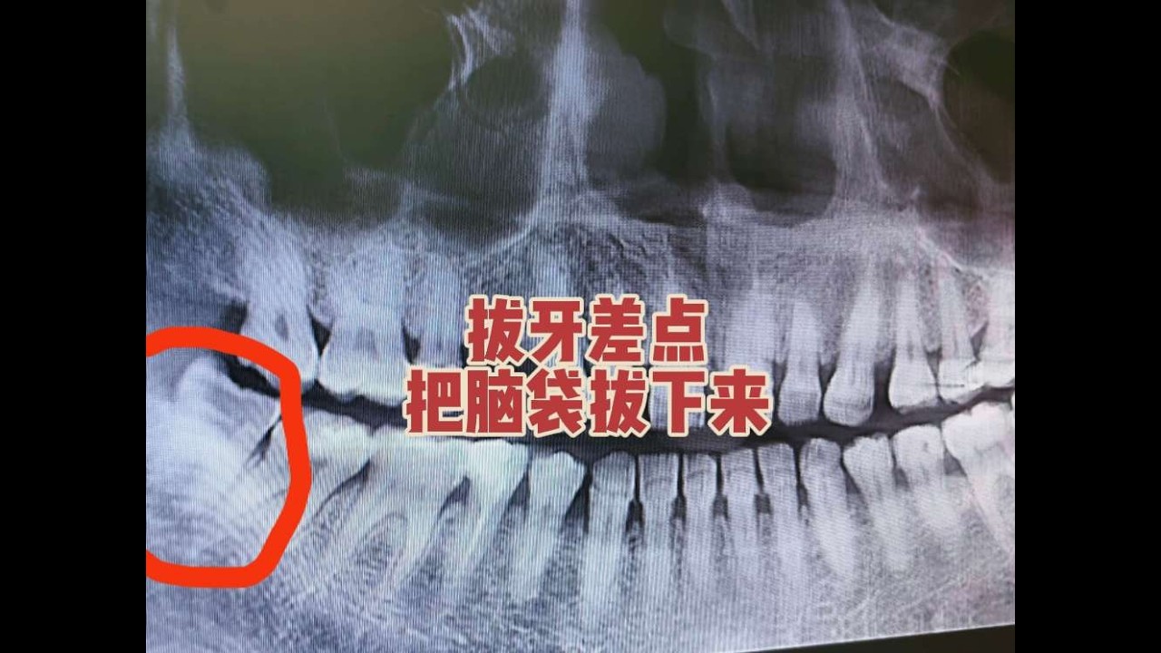拔个牙差点把我脑袋拔下来，几十年的老牙根，需要切割后拔出……