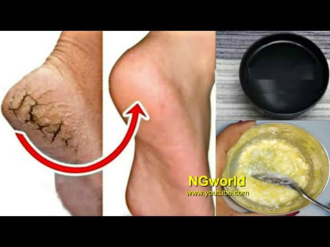 In Just 5 Minutes - Get Rid of CRACKED HEELS Permanently, Magical Cracked Heels Home Remedy