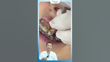 Review Quá Trình Niềng Răng Khấp Khểnh | Bác Sĩ Yên