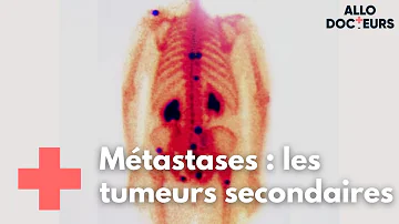 Est-ce que des nodules sont des métastases