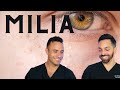 MILIA - How to treat and prevent them | Dermatologist Perspective