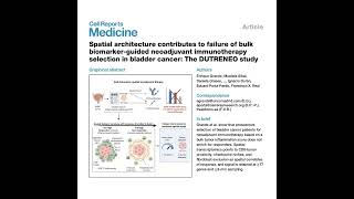 1332-Spatial Transcriptomics for Precision Bladder Cancer