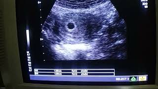 How To Find Gestational Sac With Tas Ultrasound At 4 Weeks By Dr Fatima