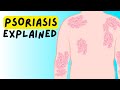 What is Psoriasis? Definition, Etiology, Classification, Pathophysiology, Diagnosis, Treatment