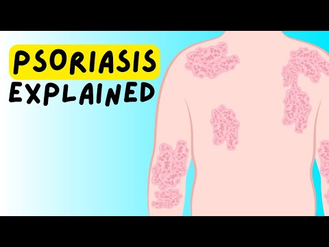 aetiology of psoriasis