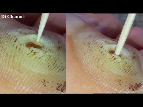 Video Chữa mụn mắt cá chân theo cách kinh dị mà hiệu quả -... - youtube