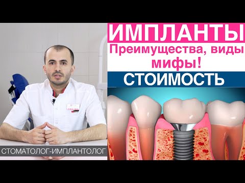 Зубные импланты - мифы, преимущества имплантов для зубов, виды имплантов, стоимость установки.