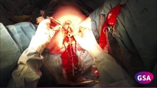 Total Laparoscopic Sigmoid Vaginoplasty