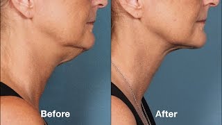 What is Kybella? Wealth