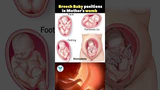 Breech Baby positions in Mother's womb | Baby in mother's belly | Pregnancy Tips