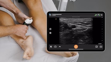 USG Tibial Nerve Block