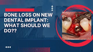 Patient Losing Bone Around New Dental Implant Placed By Dentist in a Foreign Country. What Do We Do? by North Texas Dental Surgery 9,540 views 1 year ago 16 minutes