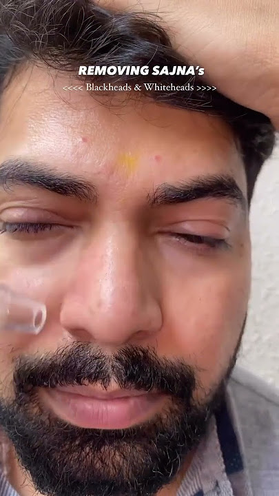 Blackhead Remover | Winston Blackhead Remover