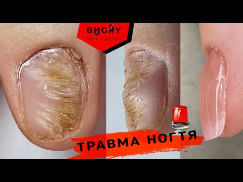 ТКНУЛА ФРЕЗОЙ В НОГОТЬ 😱 ПОСЛЕДСТВИЯ / ПРЕОБРАЖЕНИЕ СПУСТЯ ВРЕМЯ  #ТатьянаБугрий