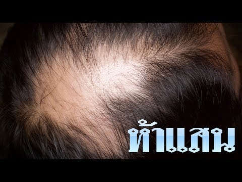หัวล้านรักษาได้ ไม่แพงอย่างที่คิด