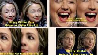 Hillary Clinton Face Before and After Face Lift #505 np
