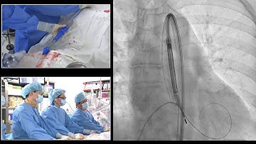 [AP VALVES & SH 2019] Live Case & Lecture 1: TAVR #2
