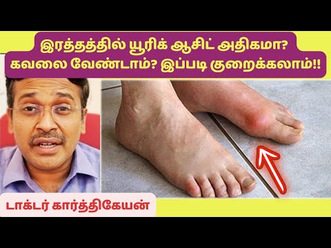 இரத்த யூரிக் ஆசிட் அளவுகளை குறைக்கும் உணவு,உடற்பயிற்சி,மருந்து | uric acid reducing foods exercise