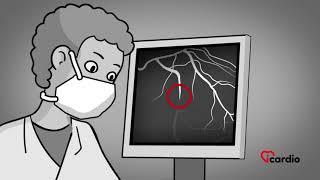 Treatment of Unstable Angina and Myocardial Infarction