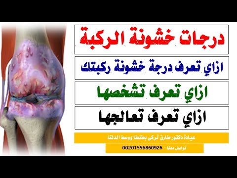 درجات خشونة الركبة و العلاج المناسب لكل درجة بدون جراحة ازاى تعرف درجة خشونة ركبتك