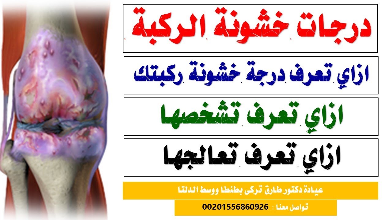 درجات خشونة الركبة و العلاج المناسب لكل درجة بدون جراحة | ازاى تعرف درجة خشونة ركبتك