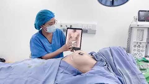 [TRỰC TIẾP] KẾT QUẢ CA NÂNG NGỰC TÚI MENTOR XTRA CHO CHỊ KHÁCH HÀNG HƯNG YÊN