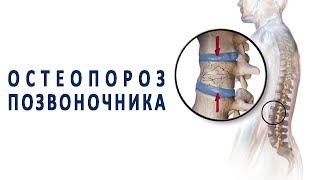 Что нужно знать об остеопорозе позвоночника Что нужно знать об остеопорозе позвоночника