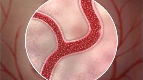 Transarterial Chemoembolization with Drug-loaded Beads