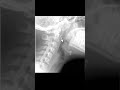 Epiglottitis #meded #ENT #infectiousdisease #emergencymedicine #medicine #criticalcare