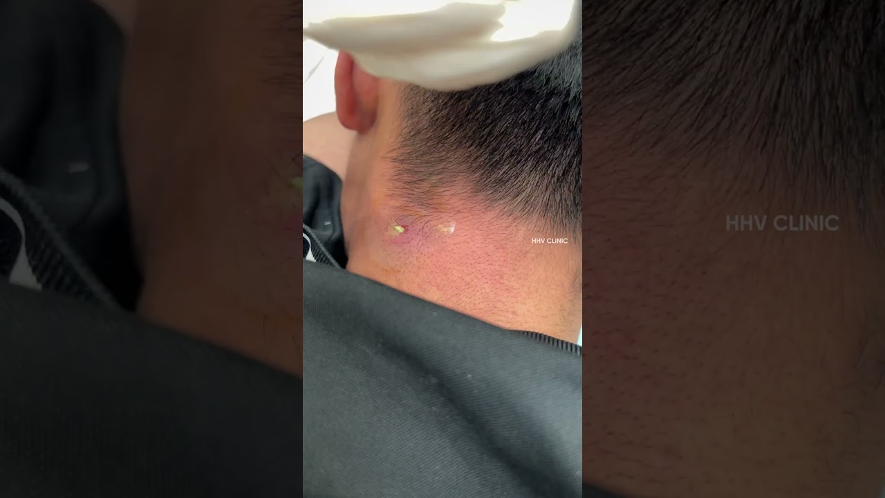 Nặn mụn nhọt ở cổ