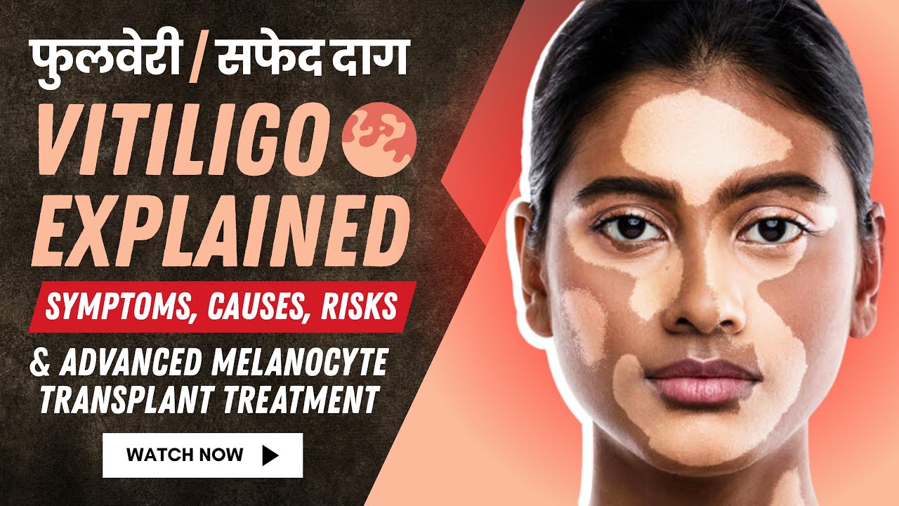 Vitiligo Treatment it's Symptoms, Causes, Risks & Advanced Melanocyte Transplant Treatment